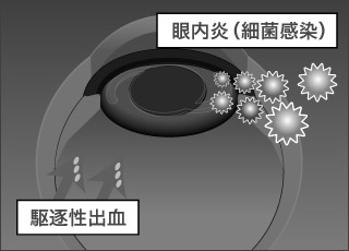 眼内炎・駆逐性出血イラスト