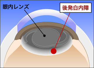後発白内障イラスト