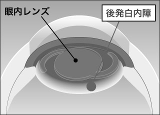 後発白内障イラスト